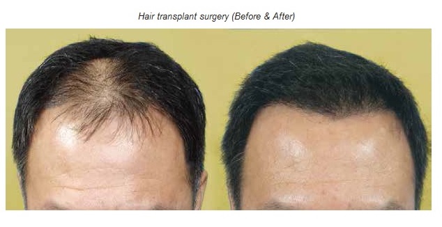 hair-transplant