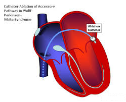 catheter