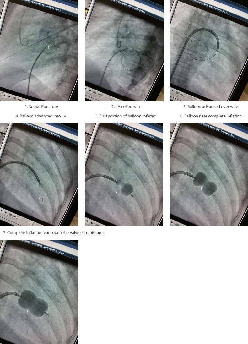 Percutaneous Trans Mitral Commissurotomies PTMC