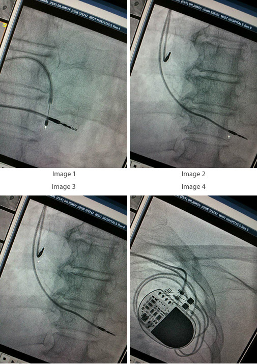 Dual Chamber Pacemaker