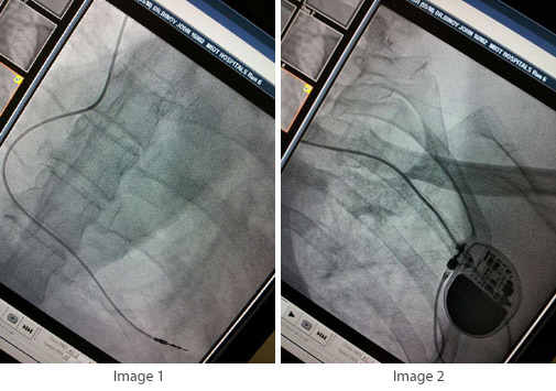 Single Chamber Pacemaker