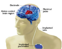 DBS-Implant