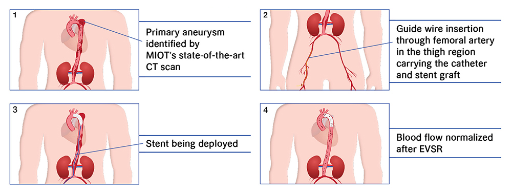 MIOT International Press Release Diagram