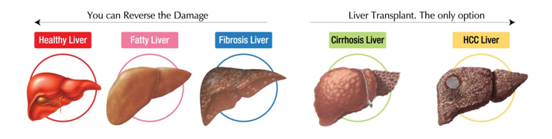 Progression of Liver Disease