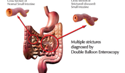 UK Patient Cured of drug induced Diaphragm disease caused by over-usage of pain killers - First such case reported in India