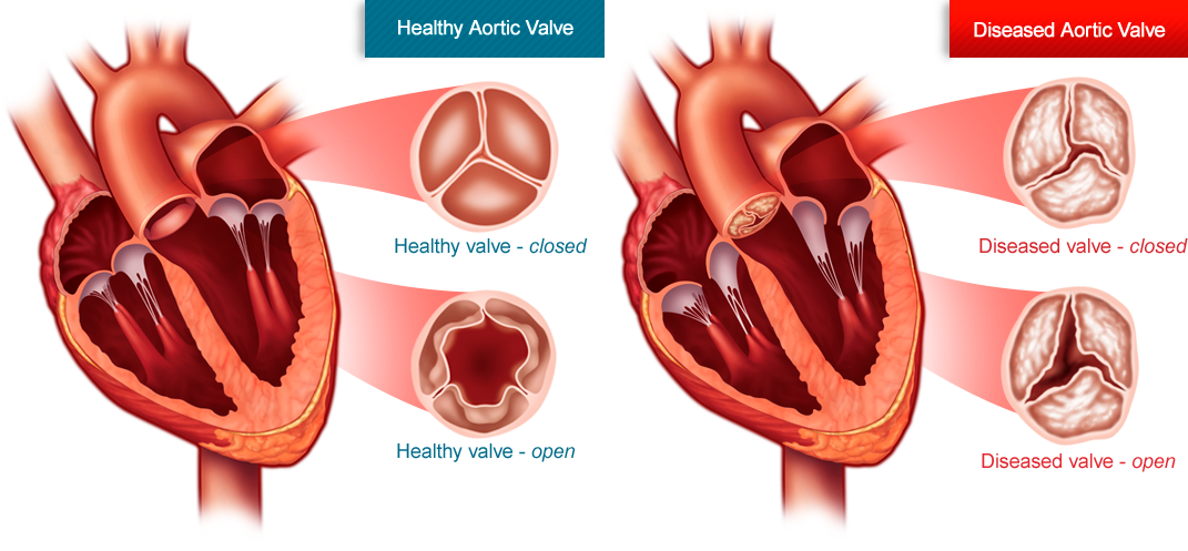 Aortic Stenosis and Surgical Treatment1