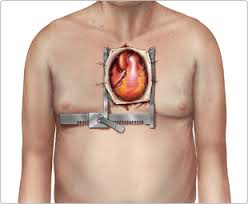 Aortic Stenosis and Surgical Treatment2