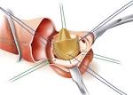 Aortic Stenosis and Surgical Treatment3