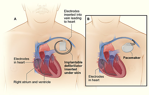 Pacemaker