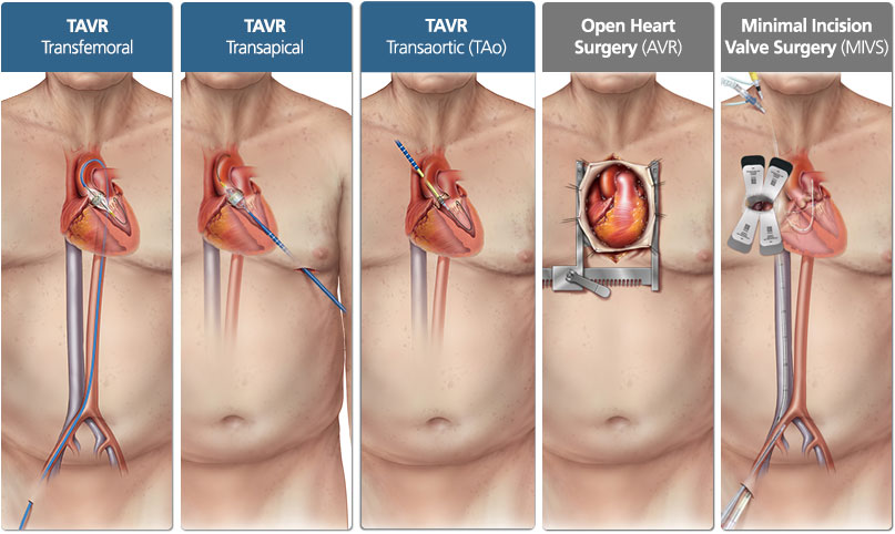 TAVI