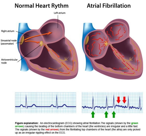 heart rhythms