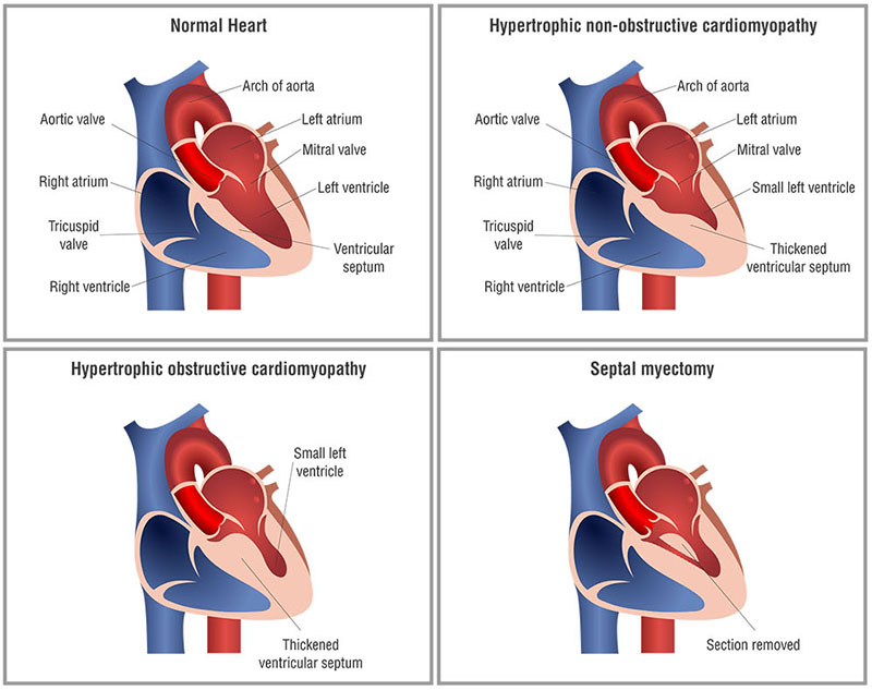 Hypertrophic cardiomyopathy