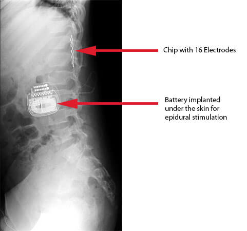 Eric-Implant