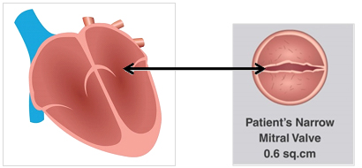 Alamelu Narrowed Mitral Valve