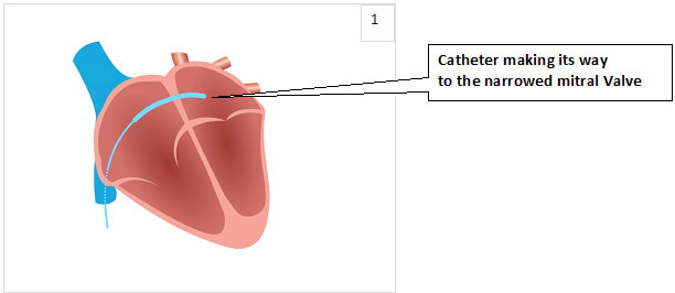 Catheter making its way