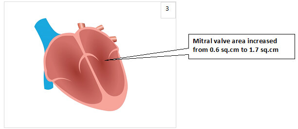 Mitral valve area increased
