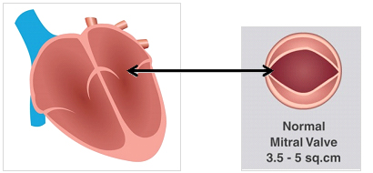 Normal Mitral Valve