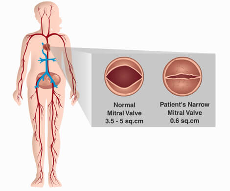 mitral valve