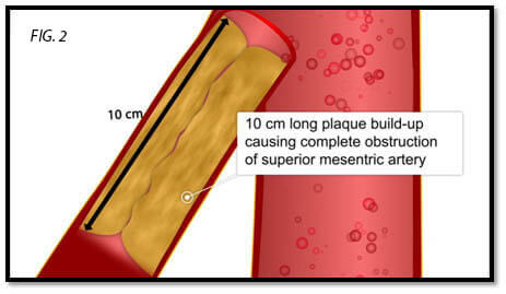 endovascular-surgery-2