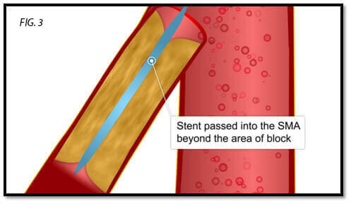 endovascular-surgery-3