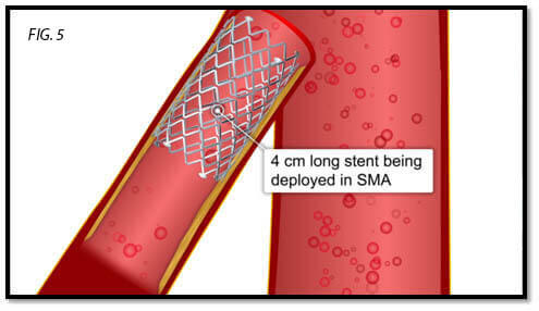 endovascular-surgery-5