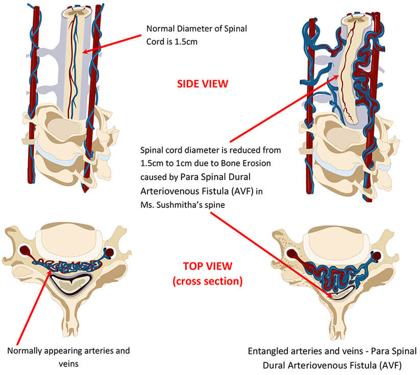 Entangled arteries and veins