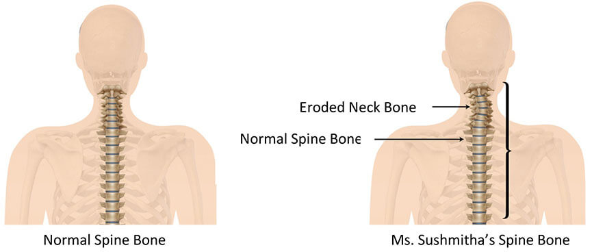 Sushmitha Spine Bone