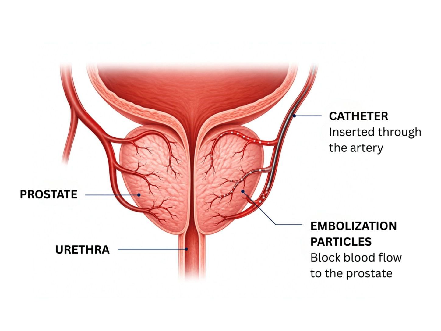 What is Prostatic Artery Embolization (PAE) - MIOT International