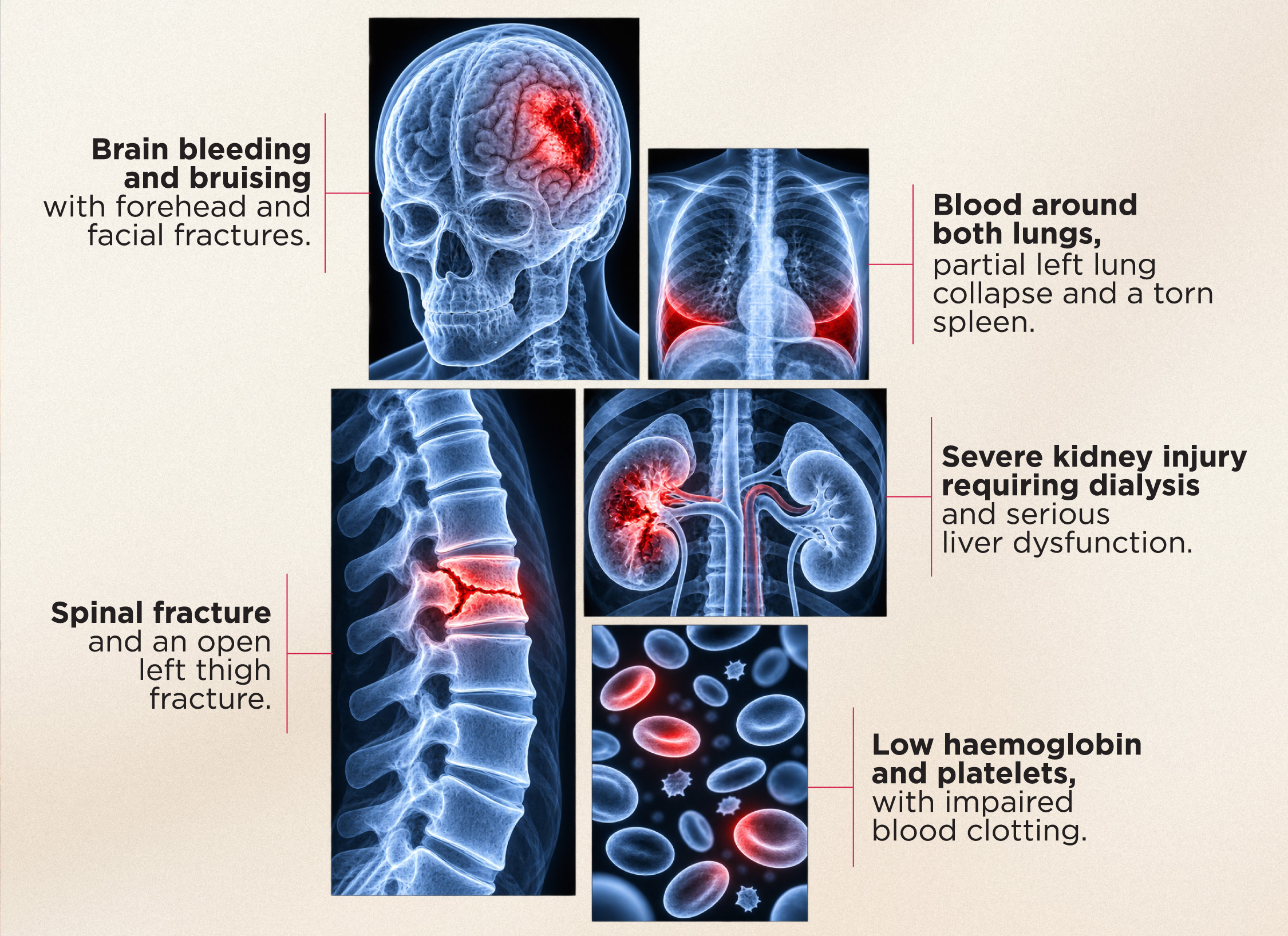 Patient Subhavijayenthiran - MIOT International